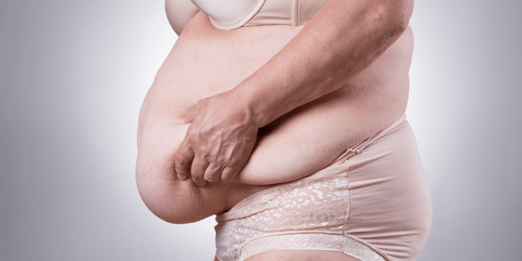 Do You Have To Lose Weight Before A Tummy Tuck?