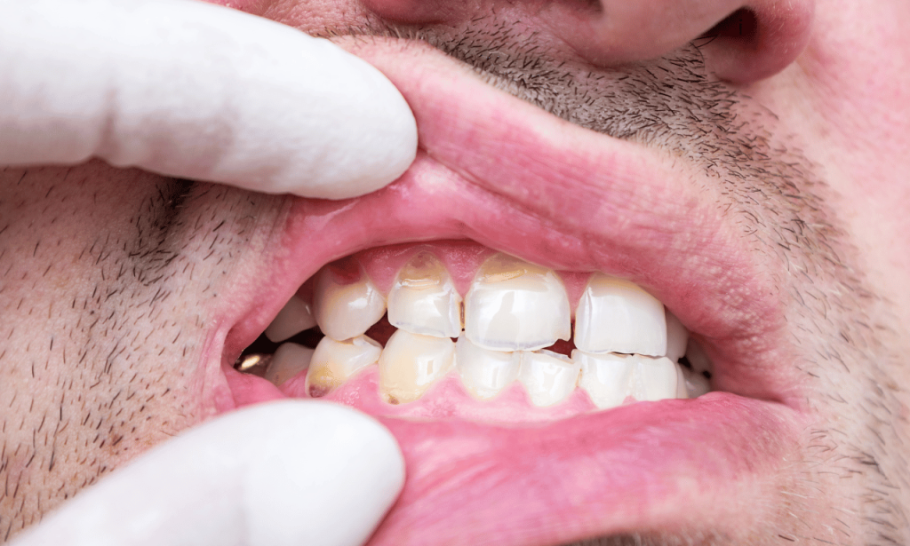 What Causes Brittle Teeth: Treatment and Prevention