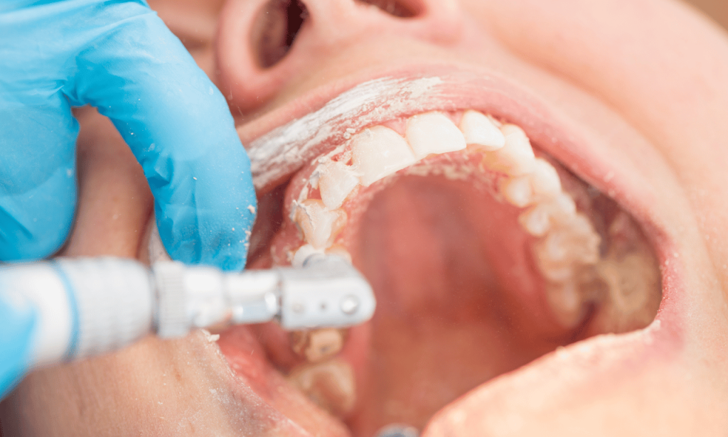 How Much Does A Dental Cleaning Cost Without Insurance?