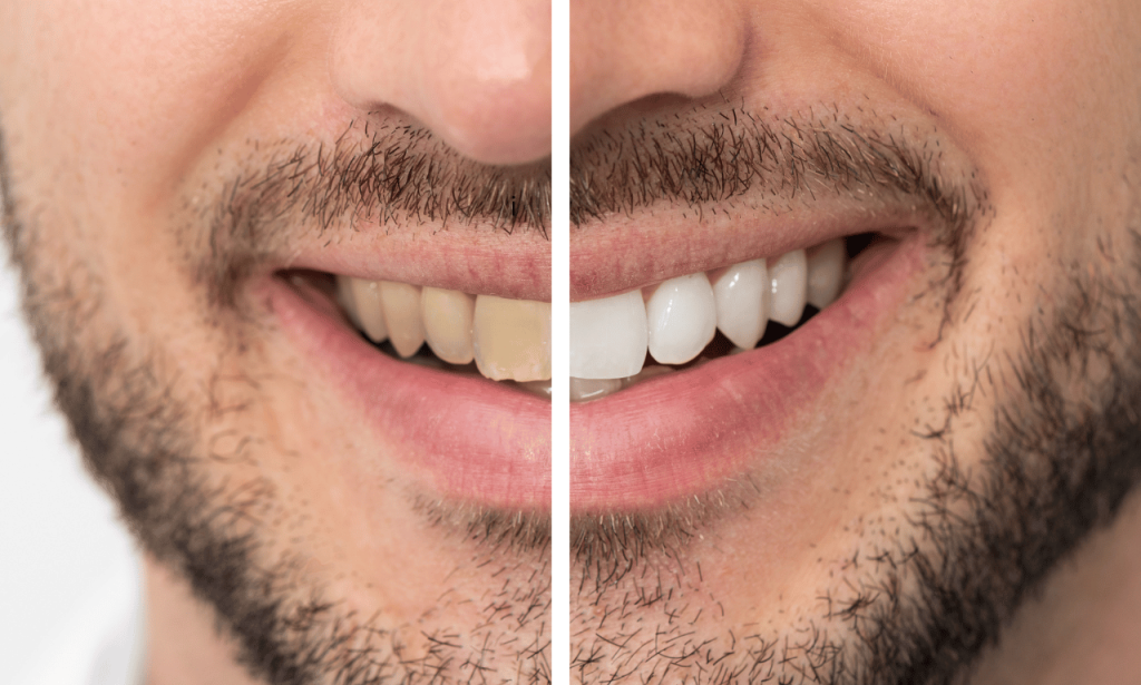 How To Whiten Teeth At Home In One Day: Fast And Effective