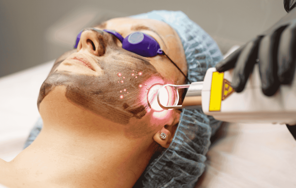 Best Laser Acne Treatment for Clear Skin: New York