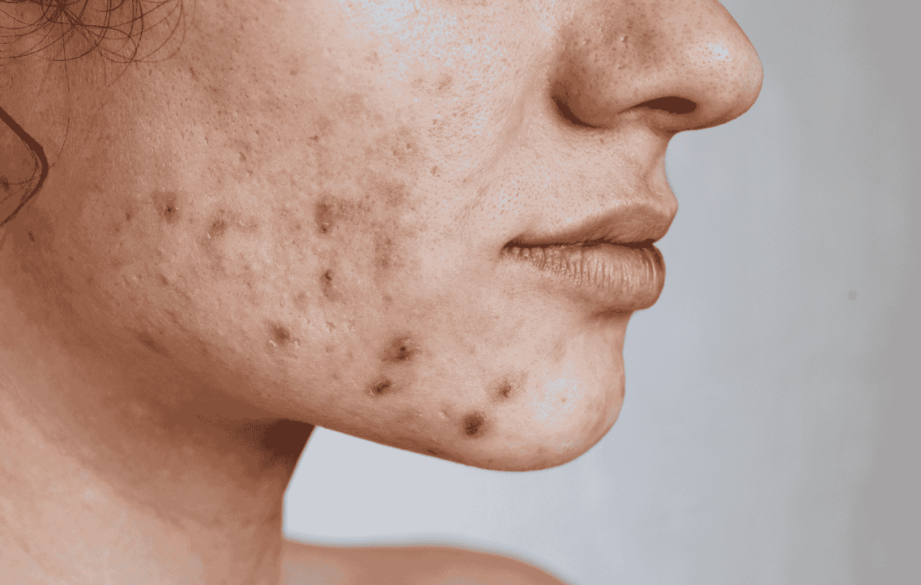 Best Laser Acne Treatment for Clear Skin: New York