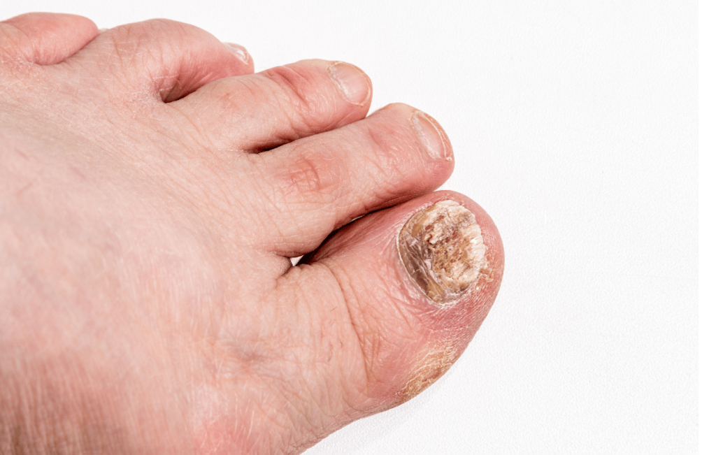 Nail Trauma vs. Toenail Fungus: Causes & Treatment