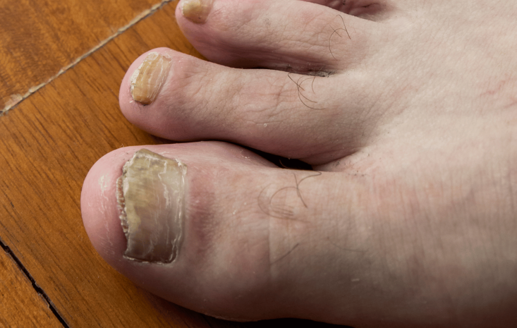 Nail Trauma vs. Toenail Fungus