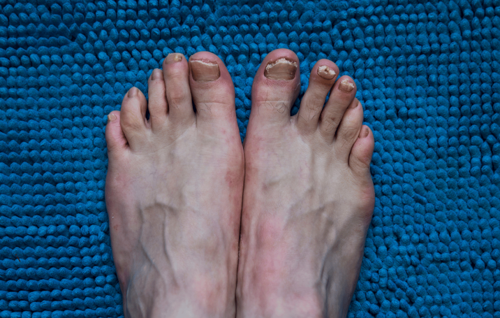 Nail Trauma vs. Toenail Fungus